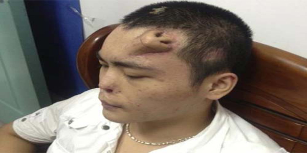 चीन में डॉक्‍टरों ने बना दी मरीज के माथे पर कृत्रिम नाक