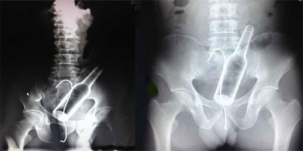 हैरतअंगेज! शख्स के पेट में मिली बोतल